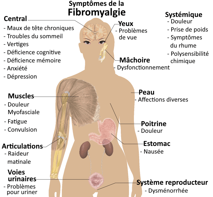 Tout savoir sur la fibromyalgie
